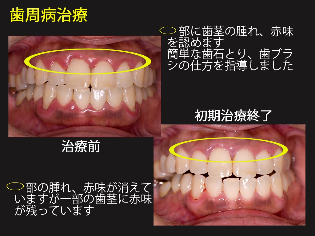 歯周病 初期治療 くろまめ日記 歯周病 初期治療 くろまめ日記