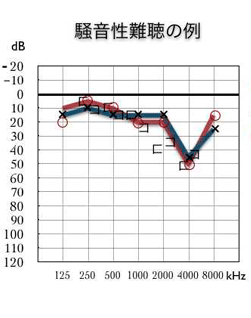 騒音性難聴_a0150513_125589.gif