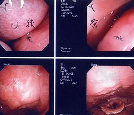 急性咽頭炎　症例１０_a0082724_16324736.jpg