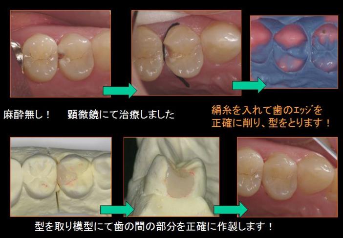 麻酔無しの無痛虫歯治療_e0163073_11501518.jpg