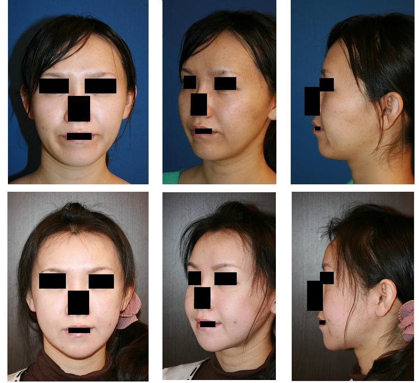 頬骨アーチリダクション、下顎骨下縁スティック骨切り術、顎下脂肪吸引、フラクショナルレーザー_d0092965_18013.jpg