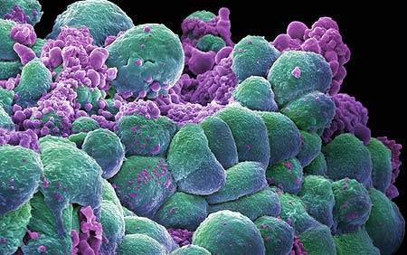 癌は真菌感染のせい！？：トゥリオ・シモンチーニ博士の「癌の治療法」_e0171614_18234338.jpg
