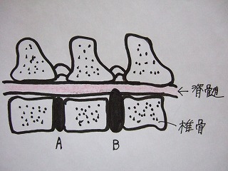 CTの活躍 その1 ―椎間板ヘルニア―_b0059154_13153031.jpg