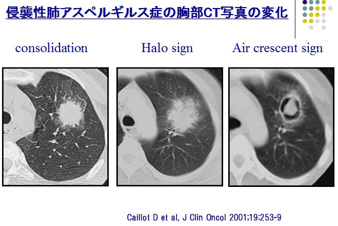 侵襲性肺アスペルギルス症（Invasive Pulmonary Aspergillosis；IPA）_e0156318_2351382.jpg