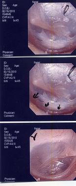 鼓膜穿孔　鼓膜炎　症例１　その４_a0082724_16281270.jpg