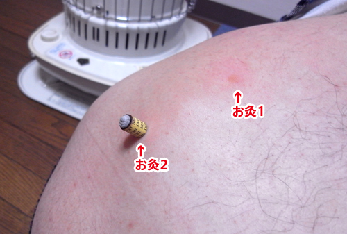 打ち身・打撲にセルフケア_b0168743_18444263.jpg