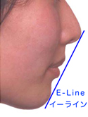 口元の変化・・・口元の横の線(しわ)・E-Lineの改善_e0025661_18581796.jpg