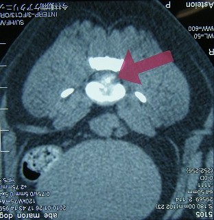 CTの活躍　その1　―椎間板ヘルニア―_b0059154_13381176.jpg