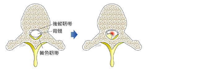 黄色靭帯骨化症_c0219358_732505.jpg