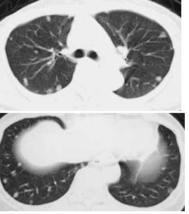 肺類上皮血管内皮腫(pulmonary epithelioid hemangioendothelioma)_e0156318_8555053.jpg