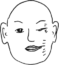 顔面痙攣_e0097212_12544138.gif