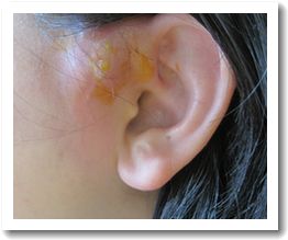 先天性耳瘻孔 その後 Hinatabocco