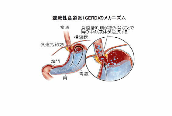 第８０５回　逆流性食道炎（GERD)　その１_d0070361_117848.jpg