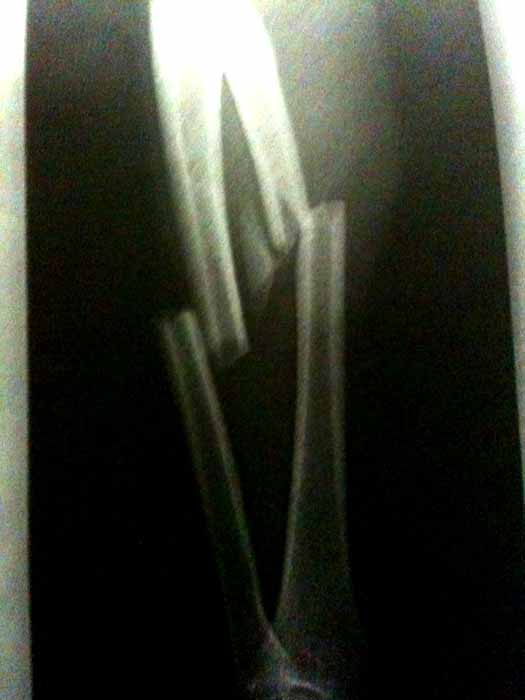 BROKEN BONES !!!_f0197414_153105.jpg