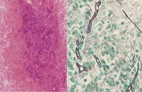 zygomycosis (ムコール症;mucormycosis)_e0156318_10414974.jpg