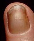 黄色爪症候群(Yellow nail syndrome)_e0156318_1122420.jpg