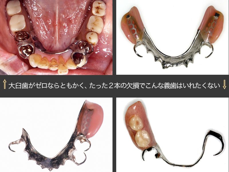 歯牙模型　補綴　歯科　下顎遊離端欠損 歯牙模型 補綴 歯科 下顎遊離端欠損 歯牙模型 補綴 歯科 下顎遊離端欠損