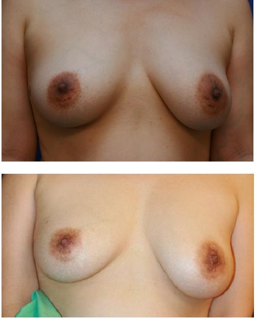 他院乳頭縮小術術後修正、 モントゴメリー腺切除術_d0092965_181596.jpg