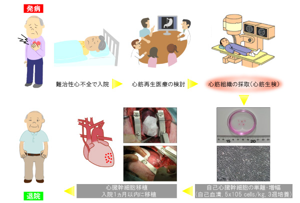 京都府立医大:患者の幹細胞使い重症心不全治療に成功_c0139575_1939234.jpg