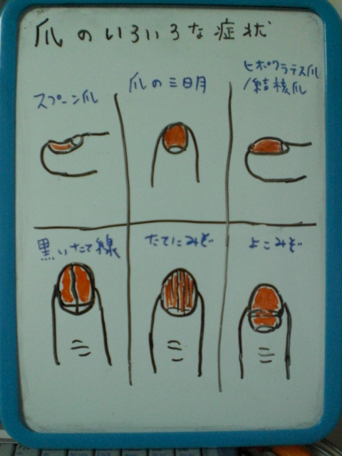 爪のいろいろな症状 健康チェック 整体 ツボゲッチューりらく屋 朝霞