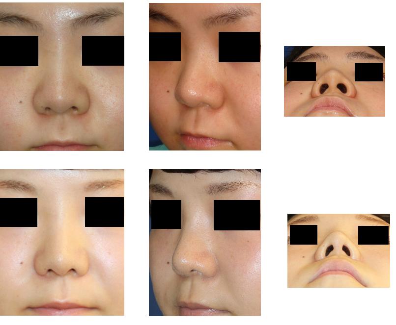 鼻プロテーゼ隆鼻術、鼻尖縮小術、小鼻縮小術　：脇山先生（若先生）_d0092965_155859.jpg