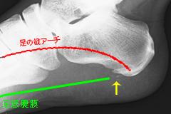 足底腱膜炎(かかとの痛み)_e0097212_14404144.jpg