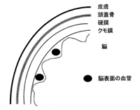 クモ膜下出血の予備知識（更新）_a0044453_7473184.gif