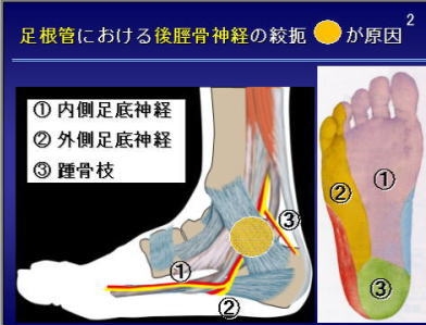 足根管症候群 ロッキー