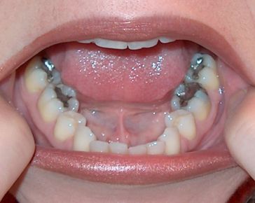 第９７７回　アメリカの歯科用アマルガム水銀についての動き_d0070361_17221485.jpg