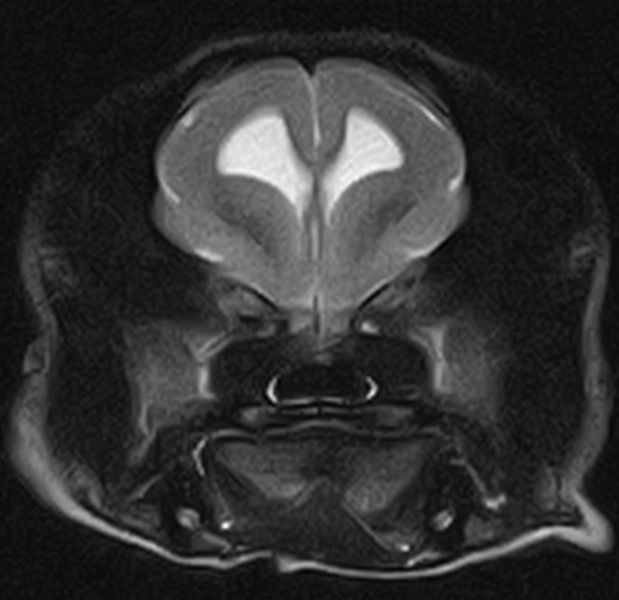 Lissencephaly　滑脳症+arachnoid cyst　くも膜嚢胞_c0032335_1018496.jpg