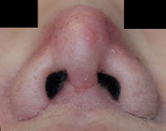 鼻尖整形　術後１ヶ月目_c0193771_16251822.jpg