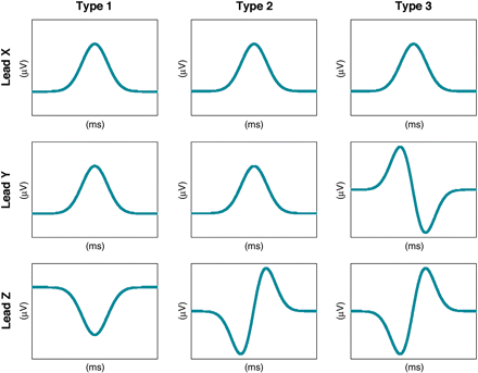 若年発症心房細動のP波の形（加算平均心電図）には特徴がある_a0119856_744213.gif