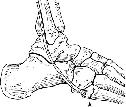 Jones Fracture_a0021482_0174266.gif