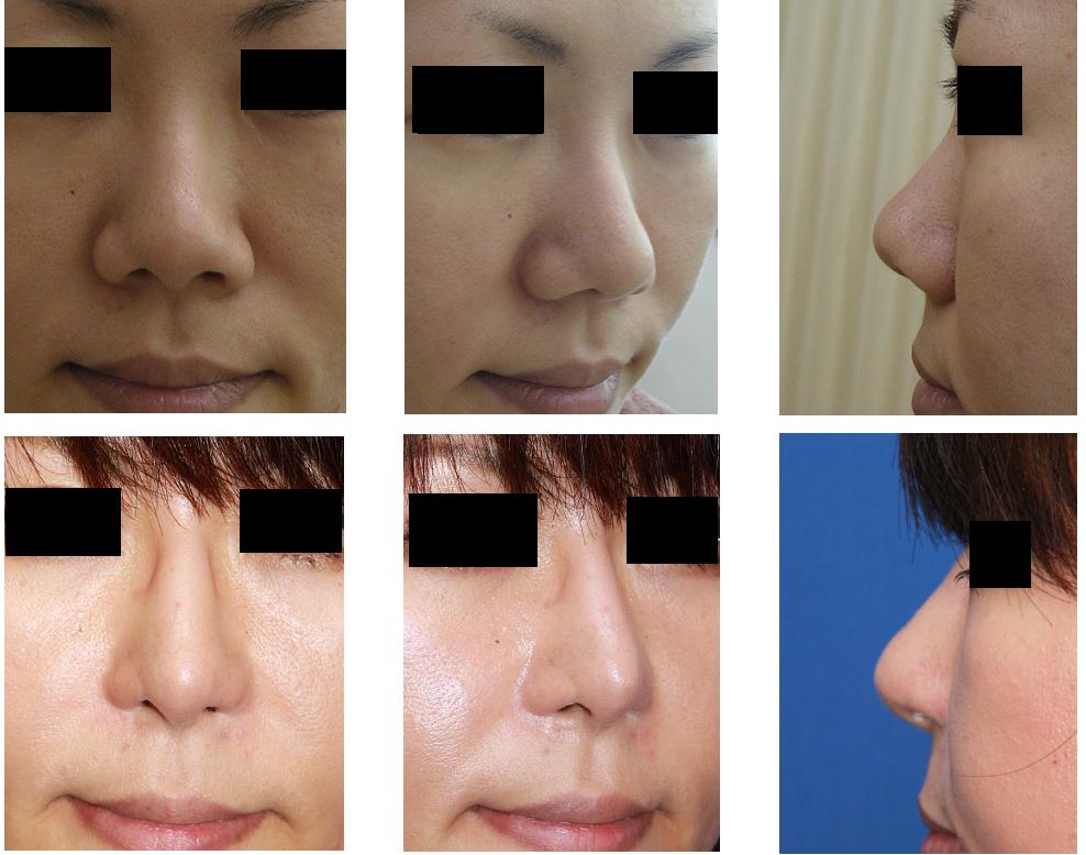 鼻翼基部プロテーゼ留置術、鼻柱下降術、鼻プロテーゼ留置術、小鼻肉厚減幅術、鼻孔縁挙上術_d0092965_23151444.jpg