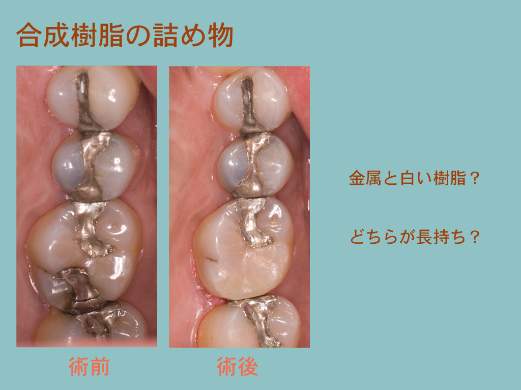 白い樹脂_a0140882_22372519.jpg