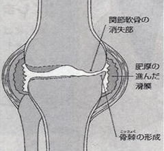 膝の外側の痛み（○○先生の症状）_e0097212_22461954.jpg