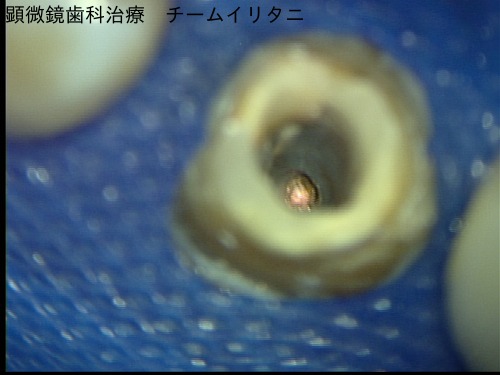 マイクロスコープが可能にしたコア（土台）除去。東京マイクロスコープ顕微鏡歯科治療_e0004468_5281893.jpg