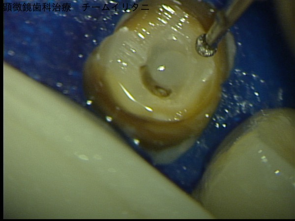 マイクロスコープが可能にしたコア（土台）除去。東京マイクロスコープ顕微鏡歯科治療_e0004468_5282458.jpg