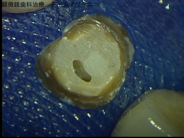 マイクロスコープが可能にしたコア（土台）除去。東京マイクロスコープ顕微鏡歯科治療_e0004468_5282740.jpg