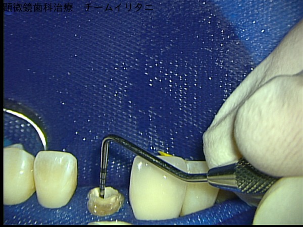 マイクロスコープが可能にしたコア（土台）除去。東京マイクロスコープ顕微鏡歯科治療_e0004468_52856.jpg