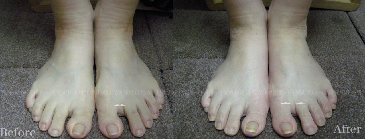 軽度の外反母趾の場合 Hallux Valgus 林足研究所 足 外反母趾 修正 日常の日記