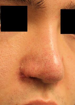 小鼻肉厚減幅術、鼻孔縁挙上術、鼻翼基部プロテーゼ（ほうれい線プロテ）留置術　：メール相談へお返事_d0092965_2191284.jpg