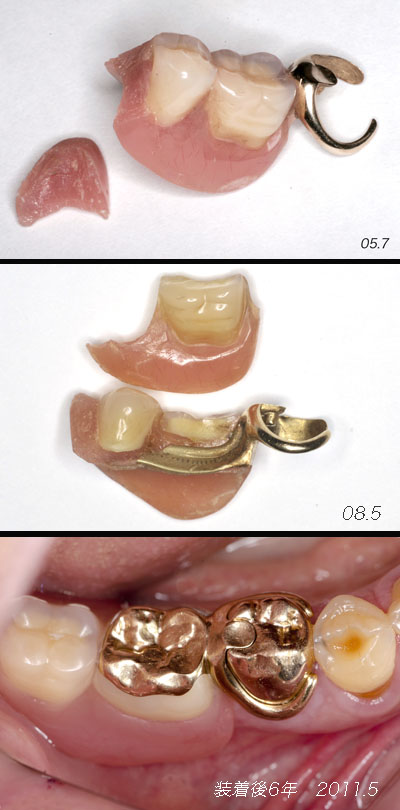 無茶な遊離端義歯 3 : 土竜のトンネル