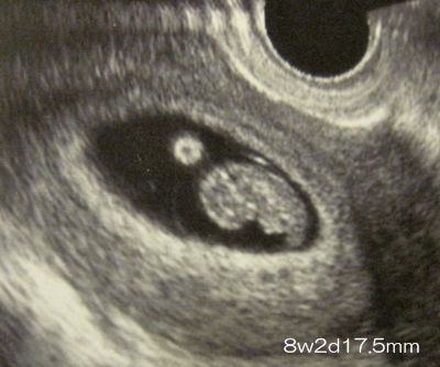 読み方 胎芽 妊娠7週｜赤ちゃんの心拍確認、つわりの症状や過ごし方【エコー写真付き】