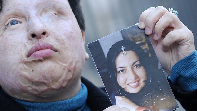 ★硫酸で失明のイラン女性、手術代と引き換えに「報復刑の免除希望」_a0028694_17501433.jpg