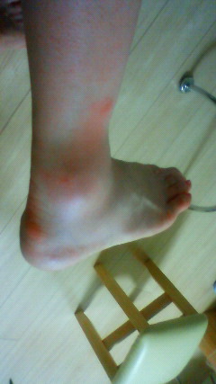 痛い ない ブヨ 歩け
