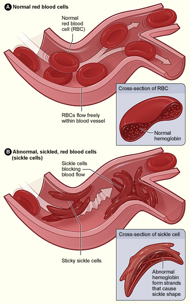 Sickle Cell Trait (鎌状赤血球形質)について学ぼう。_b0112009_2402395.jpg