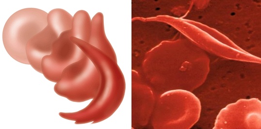 Sickle Cell Trait (鎌状赤血球形質)について学ぼう。_b0112009_791441.jpg