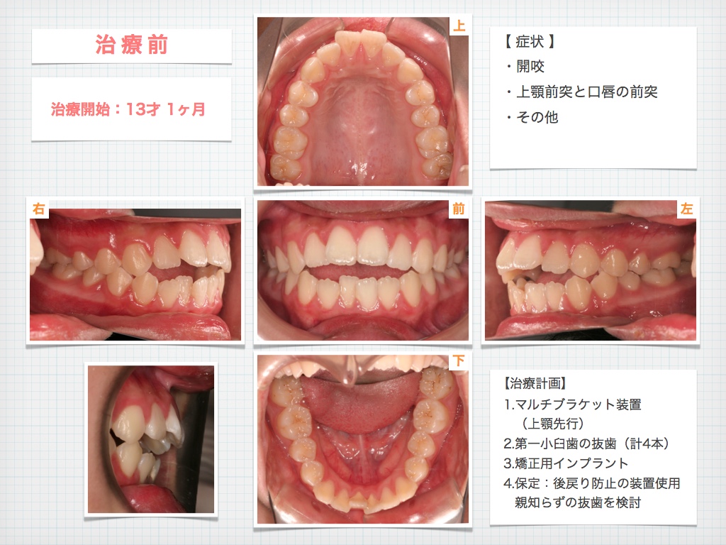 治療例:R・T さん 出っ歯と開咬の治療例_e0025661_60148.jpg
