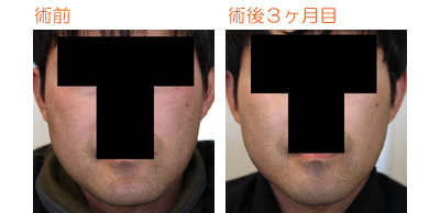 顎削り(オトガイ骨切り) 術後3ヶ月目_c0193771_11344331.jpg